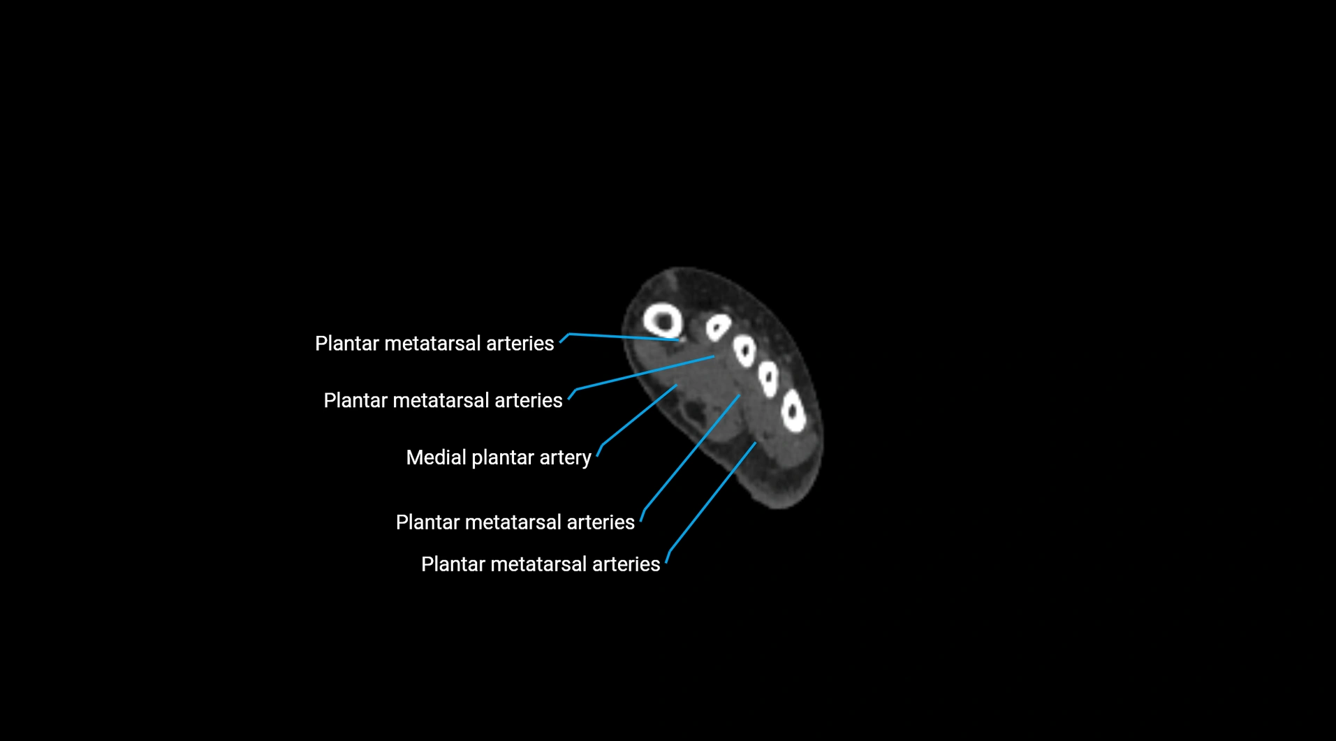 CTA lower limb cross sectional anatomy labelled image _298.webp